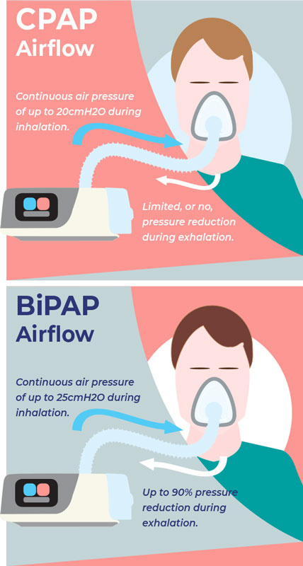 Read more about the article CPAP 面罩和 CPAP 機器壓力設置